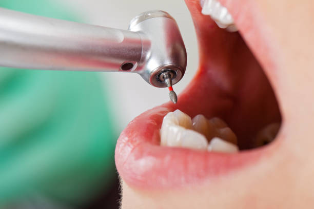 Best Broken or Cracked Tooth Emergency Dentist in Sandwich, IL